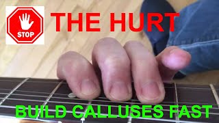 Fingers hurt from playing guitar Build calluses SECRET revealed [upl. by Nosrac]