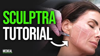 How to Inject Sculptra for Facial Volume Loss amp Glowy Skin  Full Procedure Demonstration [upl. by Eixor]