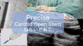 Precise Carotid Open Stent 頚動脈用オープンステントの置き方 [upl. by Mandeville]