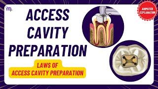 Access Cavity Preparation  Laws of ACP  Clinical tests  Procedure  Endodontics  Animated [upl. by Pravit]