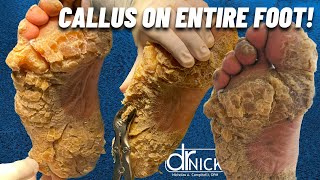 SHAVING CALLUS ON ENTIRE SOLE OF FOOT Dr Nick Campitelli Foot amp Ankle Surgeon [upl. by Reede818]