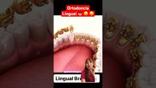 Brackets linguales 👅 ortodoncia ortodoncialingual brackets bracketslinguales orto [upl. by Domenico]