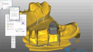 passerelle 3shape exocad telescope [upl. by Bertsche23]