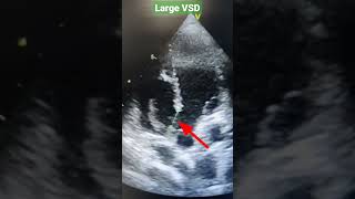 Perimembranous VSD Echo Ventricular septal defect shorts [upl. by Lairea]