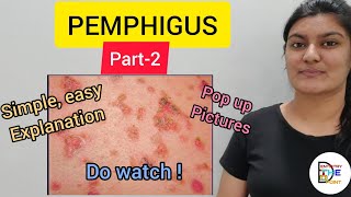 SKIN LESIONS PEMPHIGUS PART2 [upl. by Eislel177]