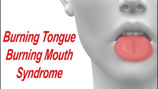 Burning Tongue and Burning Mouth Syndrome Causes and Treatment [upl. by Erdnoed]