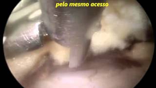 Vídeo Endoscopia de Coluna  Estenose de Canal Vertebral Lombar L45  Dr Marco Moscatelli [upl. by Niawd]