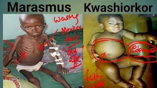 Protein Energy Malnutrition Biochemistry  Marasmus Vs Kwashiorkor  Kwashiorkor  Marasmus [upl. by Akirahc601]