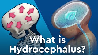 What is Hydrocephalus and Why Does Fluid Build Up in the Brain [upl. by Castor]