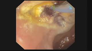 EUS evaluation and management of Ampullary lesions [upl. by Urion]