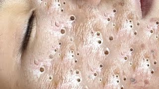 Big Cystic Acne Blackheads Extraction Blackheads amp Milia Whiteheads Removal Pimple Popping  8246 [upl. by Marela516]