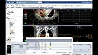 Week 1  3D vs IMRT Lung [upl. by Attalanta30]