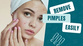 Pimples Removal on Face at Home in Tamil  Easy Pimples Treatment  24 Tamil [upl. by Dnalor713]