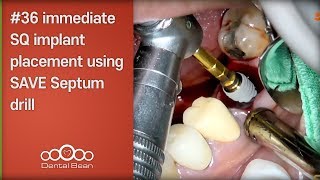 36 immediate SQ implant placement using SAVE Septum drill  Dr Kim Yongjin [upl. by Uriisa393]