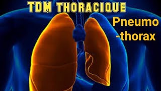 SCANNER THORACIQUE Pneumothorax avec collapsus passif [upl. by Arretak]