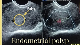 Ultrasound Report of endometrial polyp Sonography of Endometrial masspolyp [upl. by Nylime744]