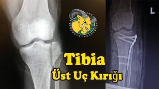 Tibia Üst Uç Kırığı Tedavi süreci 1Hafta İnstagram megenes  Bisiklet Kazası [upl. by Hnil]