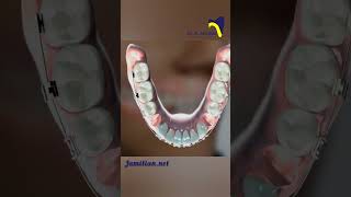 Lower first Premolar Extraction in Class III Malocclusion Correction dentist class3 orthodontics [upl. by Witcher320]