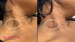 Skin Tag Removal  Dr Shalini Gupta [upl. by Zephan]