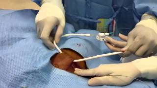 Tunneled Dialysis Catheter Insertion [upl. by Gratia]