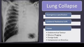 Chest Xray in Lung Collapse Findings and Causes explained chestxray radiology cxr [upl. by Gerc]