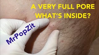 Very full pore Let’s see what’s inside Do you think it’s just a clogged pore or is there a sac [upl. by Veator]