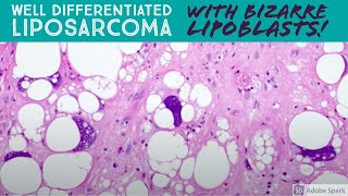 Well differentiated liposarcoma with BIZARRE pleomorphic lipoblasts 5Minute Pathology Pearls [upl. by Madalyn]