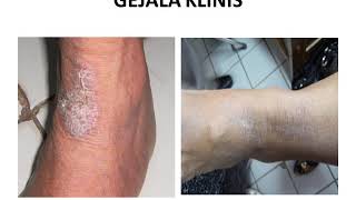 NEURODERMATITIS  Materi Kedokteran  Dermatologi [upl. by Eedak]