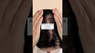 hair alopecia home remedyalopecia areata natural treatmentalopecia hair growthhaircare [upl. by Seeto213]