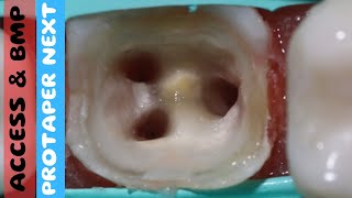 Root Canal Treatment 🔵 Mandibular Molar 🟡Access Opening🟢Biomechanical Preparation ⚪️ PROTAPER Next [upl. by Yael428]