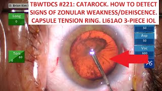 TBWTDCS 221 How To Detect Signs amp Manage Weak Zonules Capsule Tension Ring LI61AO IOL [upl. by Anauqat]