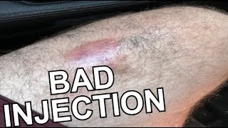 UPDATE on my almost amputate my leg CURECREAM LEG INJECTION HORROR STORY [upl. by Behre]