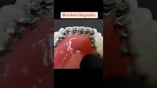 brackets linguales odonto brackets ortodoncia parati viral dentista dienteschuecos [upl. by Eynttirb]