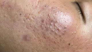 ACNE TREATMENT VU QUYNH MI  Blackheads On Boy Chin 2024FULL [upl. by Feilak]