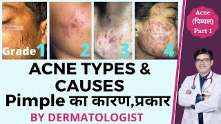 Acne Types and Causes In Hindi  Acne Types with Pictures  Pimple Ke Prakar  Dr Sunil [upl. by Akener]