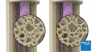 How osteoporosis develops  Bupa Health [upl. by Lonne]