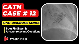 Case 12 Cath Spot Diagnosis Case Series  Interventional Cardiology [upl. by Monaco]