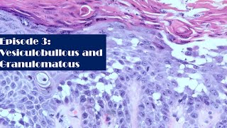 Episode 3 Vesiculobullous and Granulomatous [upl. by Amlet]