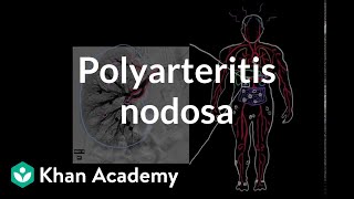 Polyarteritis nodosa  Circulatory System and Disease  NCLEXRN  Khan Academy [upl. by Kimbra]