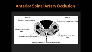 Complete Occlusion of Anterior Spinal Artery [upl. by Ahsinal]