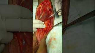 antomy of forearm of pt during fasciotomy [upl. by Yrrab393]