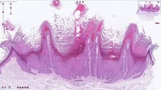 Verruca Vulgaris  Histopathology [upl. by Nylirret]