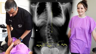 Scoliosis Evaluation For A Back Brace Headaches amp Back Pain Helped ​ Part 4 [upl. by Ataliah473]