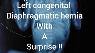 Left congenital diaphragmatic hernia with postoperative pneumoperitoneum [upl. by Dwane]