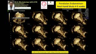 Penebalan Endometrium 45 weeks [upl. by Aicnilav666]