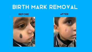 See the Shift Birthmark Removal Journey  Before and After Laser lasertherapy birthmarkremoval [upl. by Eltsryk271]