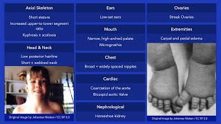 Turner Syndrome Dysmorphic Features [upl. by Llerdnek518]