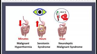 Le Syndrome Malin des Neuroleptiques Antipsychotiques Antidepresseurs Sérotonine Pharmacologie 3 mn [upl. by Anihc222]