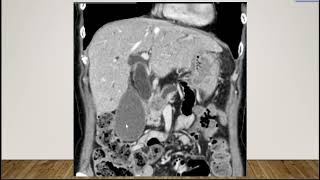 Short Case Discussion  Pancreatic ductal adenocarcinoma [upl. by Rehpinnej]