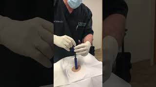 Bone Marrow Aspiration Technique with Marrow Cellution [upl. by Lemrahc]